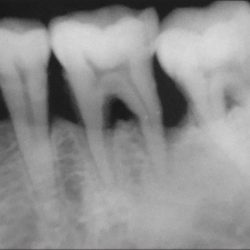 Severe bone loss in teeth xray